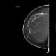 Breast carcinoma, small: MMG - Mammography